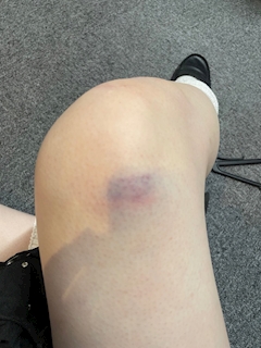 青タンできた😢😢😢